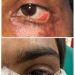स्किन ग्राफ्टिंग से मरीज की पलक का सफल पुनर्निर्माण, डॉक्टरों की बड़ी उपलब्धि