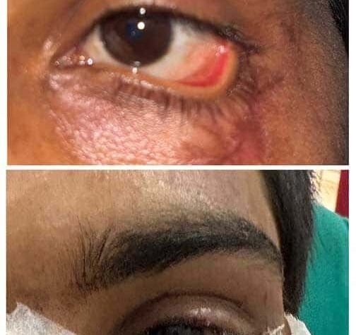 स्किन ग्राफ्टिंग से मरीज की पलक का सफल पुनर्निर्माण, डॉक्टरों की बड़ी उपलब्धि