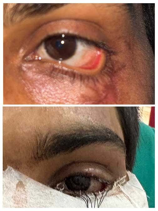 स्किन ग्राफ्टिंग से मरीज की पलक का सफल पुनर्निर्माण, डॉक्टरों की बड़ी उपलब्धि