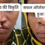 मुस्कान लौटी, बदली जिंदगी—22 वर्षीय युवती ने जन्मजात होंठ की विकृति पर पाई जीत