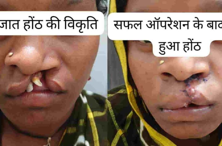मुस्कान लौटी, बदली जिंदगी—22 वर्षीय युवती ने जन्मजात होंठ की विकृति पर पाई जीत