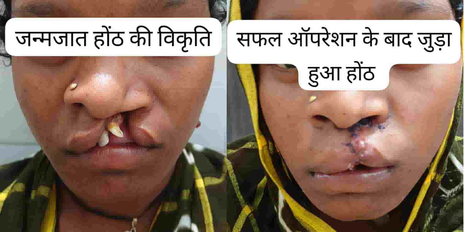 मुस्कान लौटी, बदली जिंदगी—22 वर्षीय युवती ने जन्मजात होंठ की विकृति पर पाई जीत