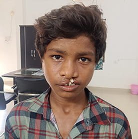 सफलता की कहानी: ‘चिरायु’ दल ने जन्मजात कटे होंठ और तालु से दिलाई मुक्ति