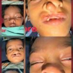 चिरायु योजना से तीन बच्चों को जन्मजात समस्या से मिली राहत