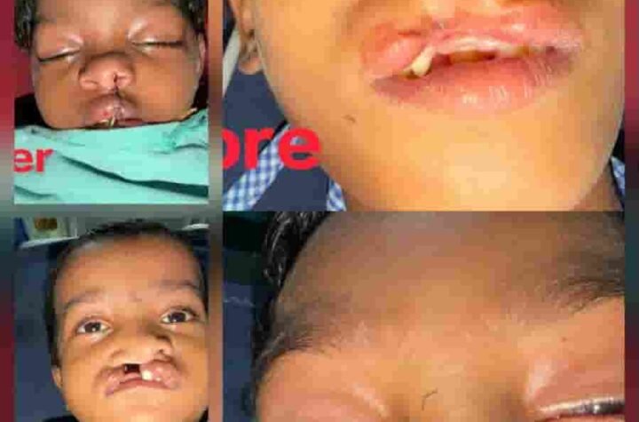 चिरायु योजना से तीन बच्चों को जन्मजात समस्या से मिली राहत