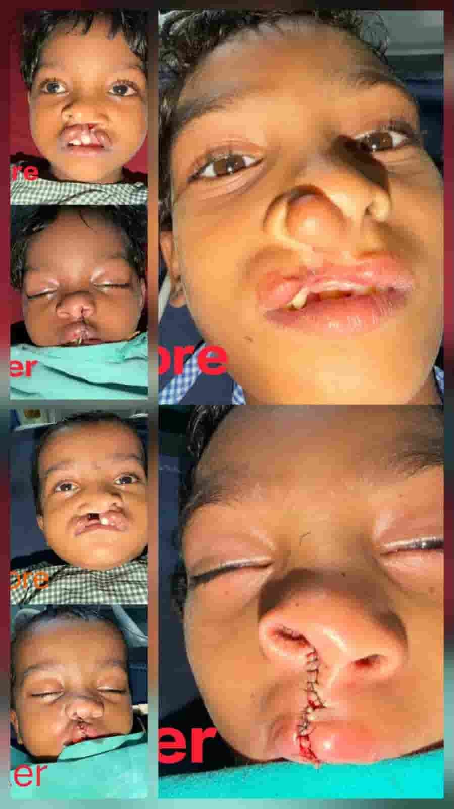 चिरायु योजना से तीन बच्चों को जन्मजात समस्या से मिली राहत